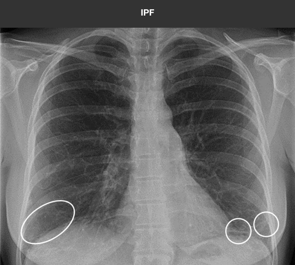 IPF x-ray scan