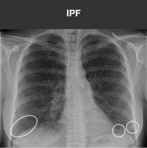 IPF x-ray scan