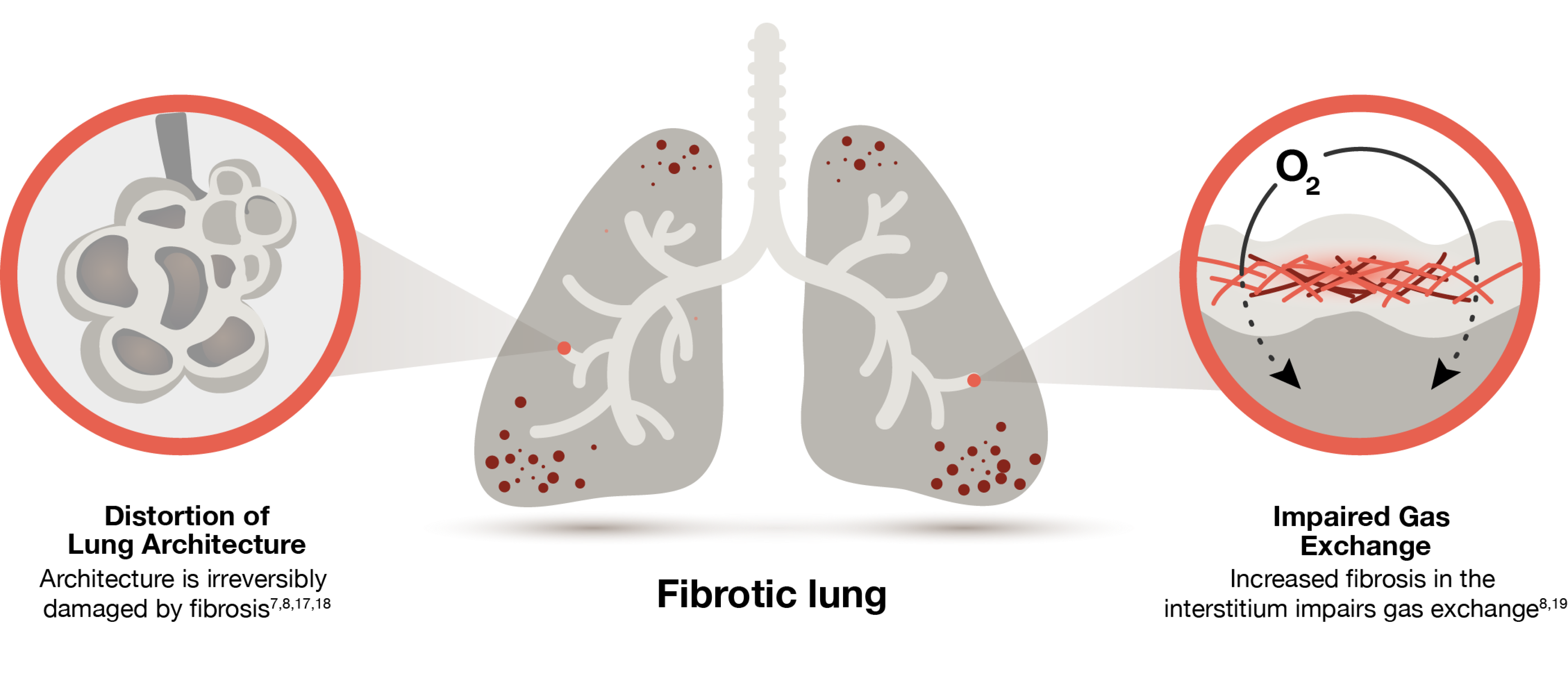fibrotic lung graphic