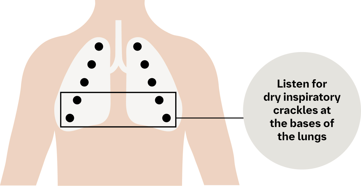 listen for dry inspiratory crackles at the bases of the lungs graphic