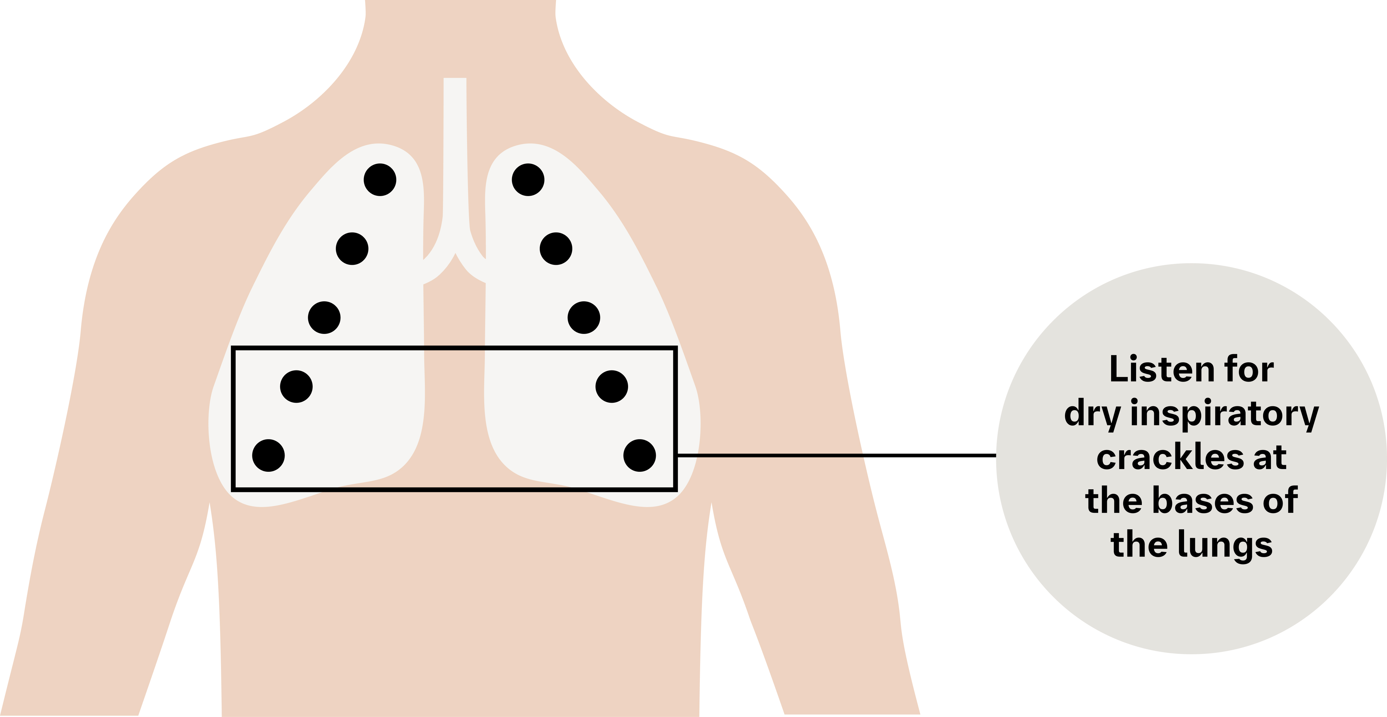 listen for dry inspiratory crackles at the bases of the lungs graphic