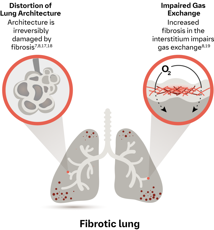 fibrotic lung graphic