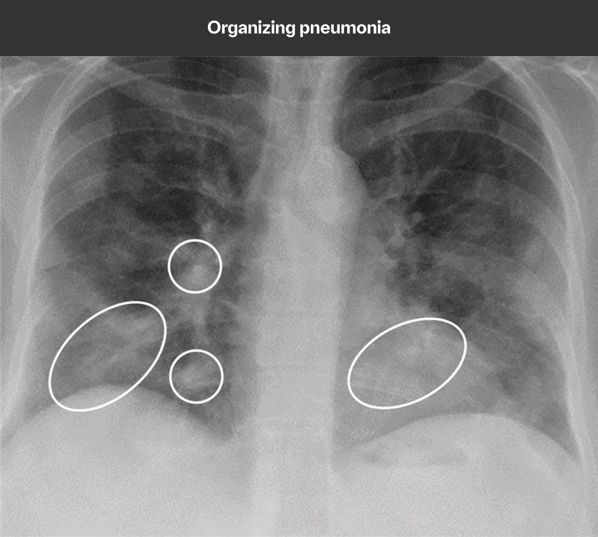 organizing pneumonia x-ray scan