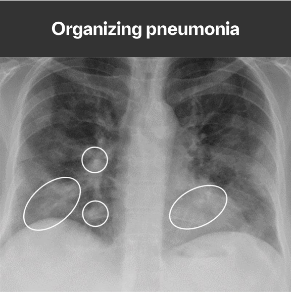 organizing pneumonia x-ray scan