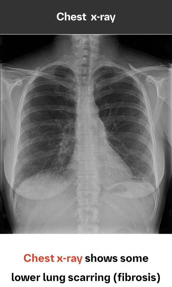 chest x-ray chest x-ray
