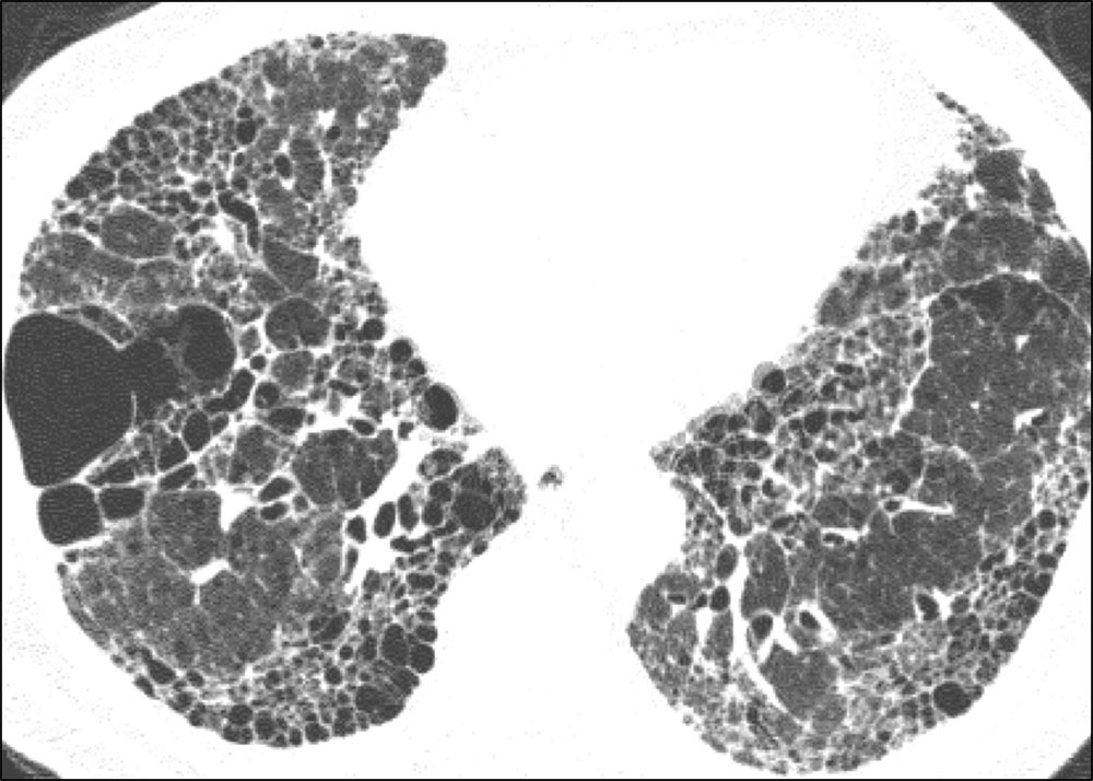 Axial HRCT image