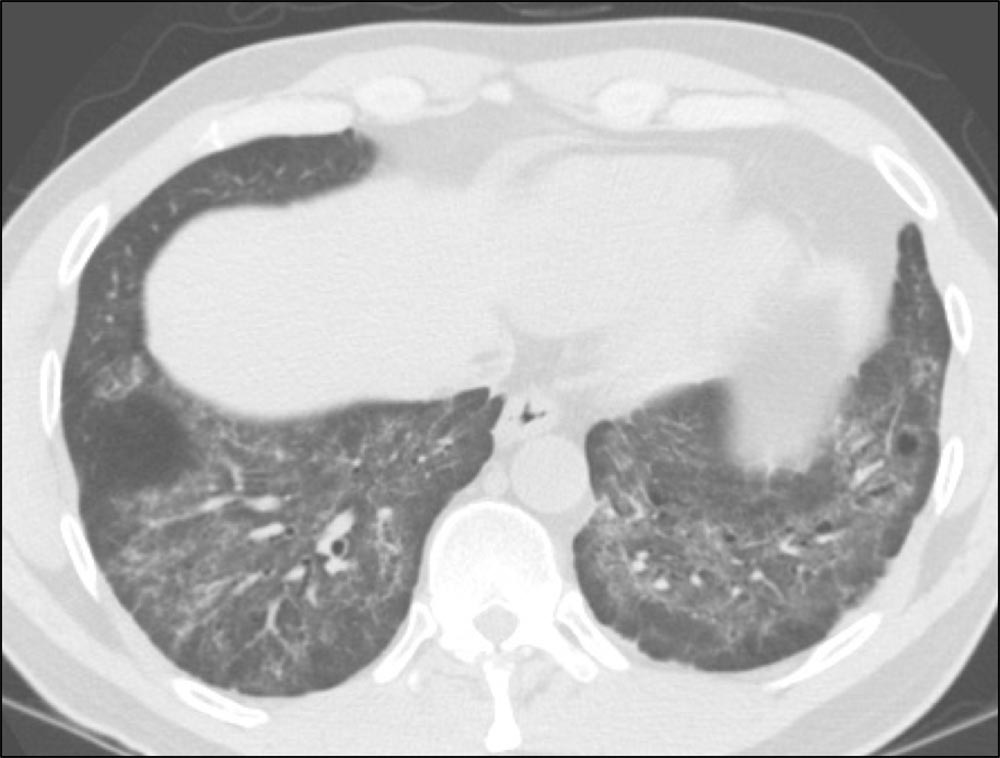 Axial HRCT scan