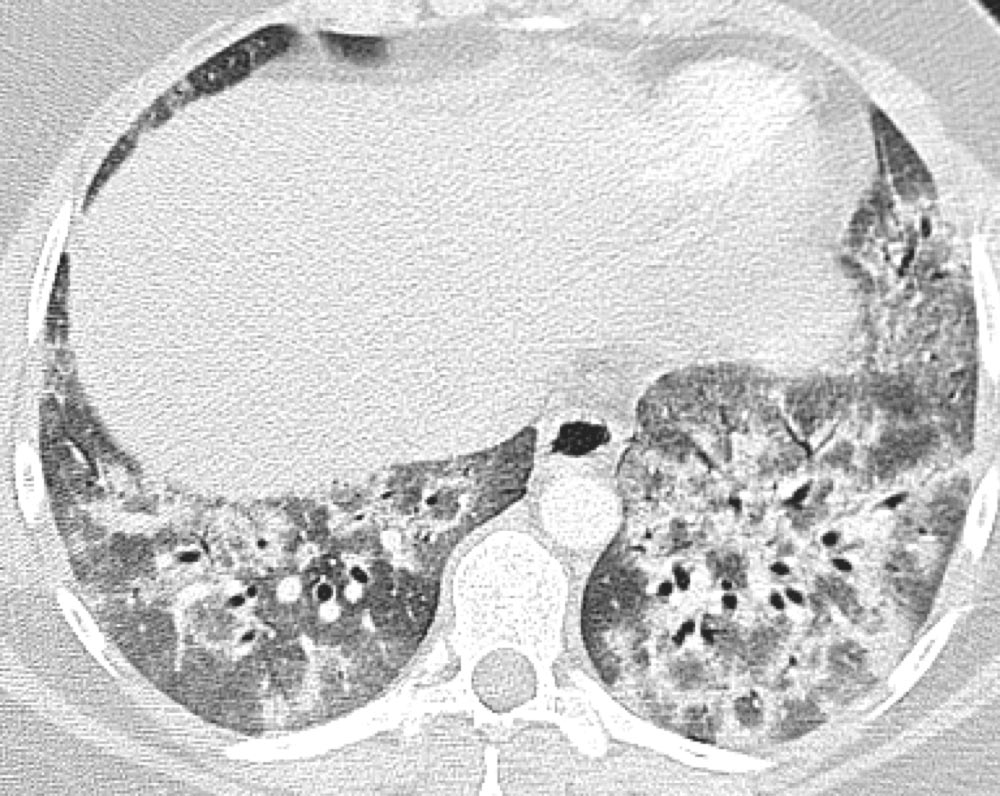 Axial HRCT scan