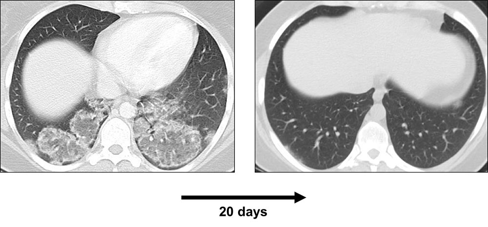 Axial HRCT scan