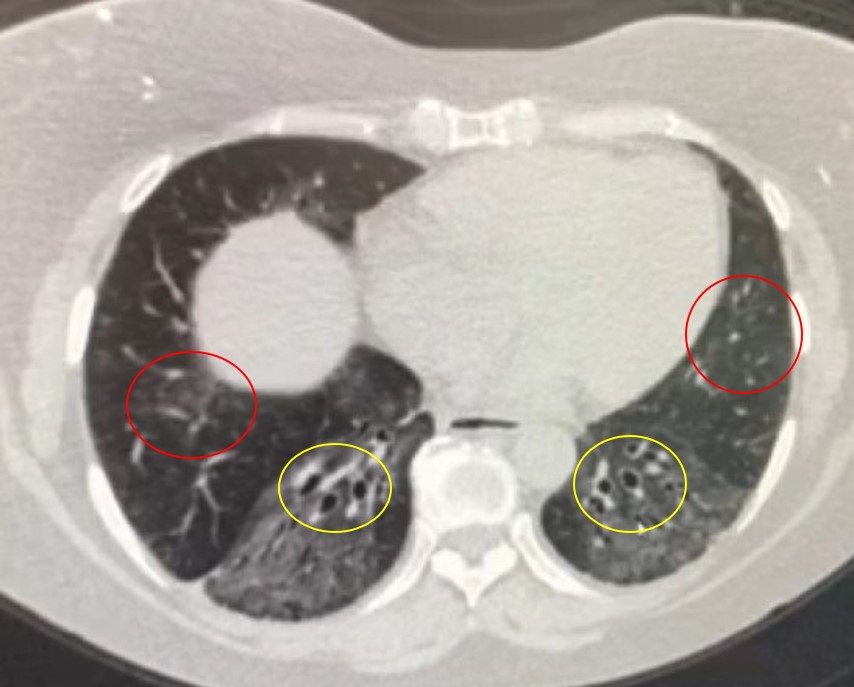 CT scan Example