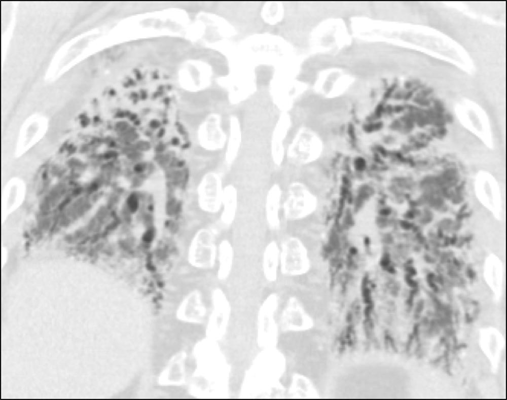 Coronal HRCT scan