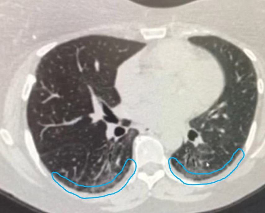 CT scan