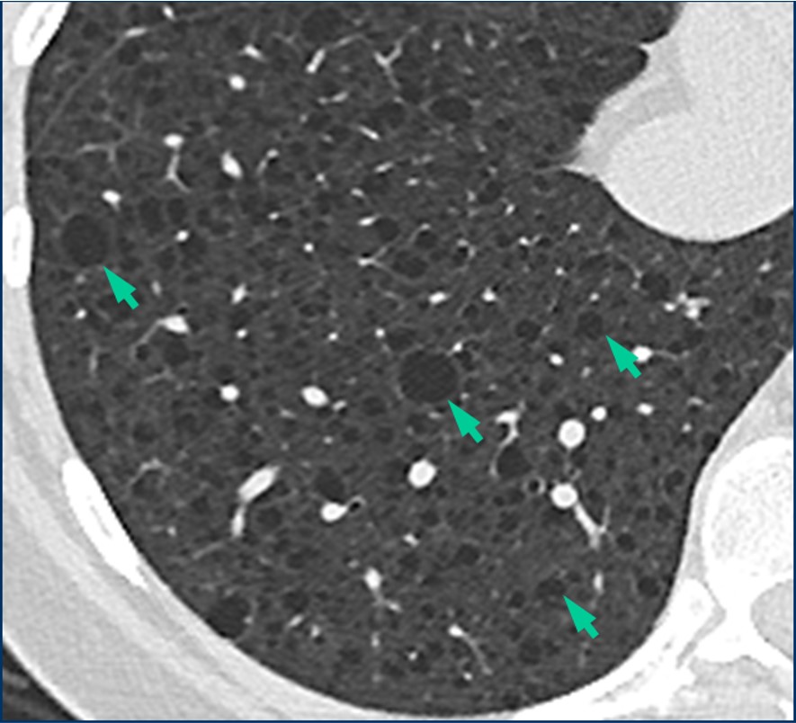 Discrete cysts