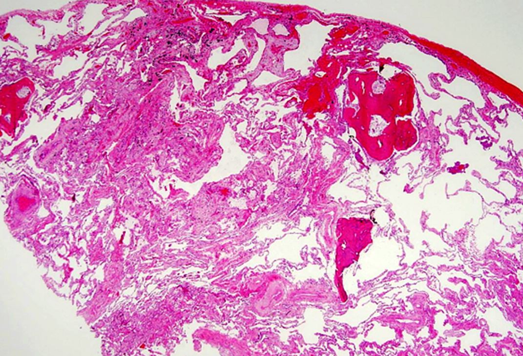histopathology indeterminate pattern