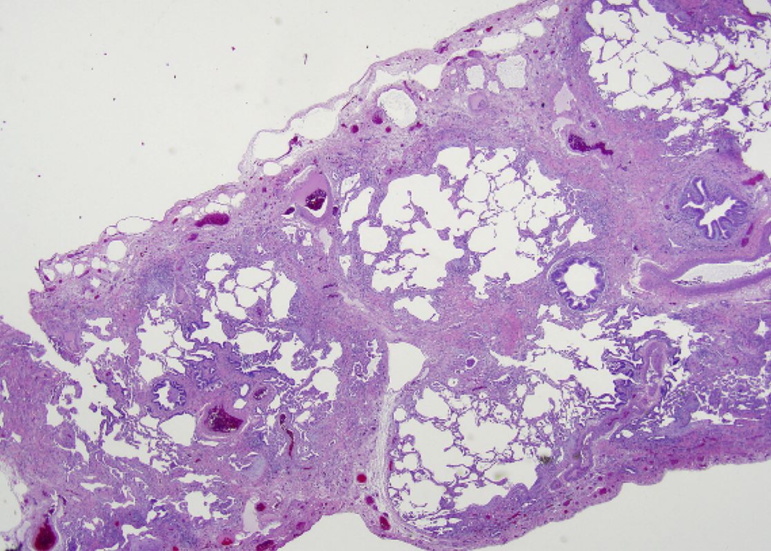 histopathology probable uip pattern
