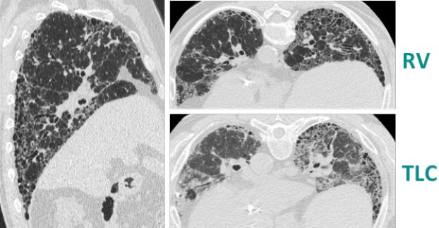 HRCT scan 1 of 4 HRCT scan 1 of 4