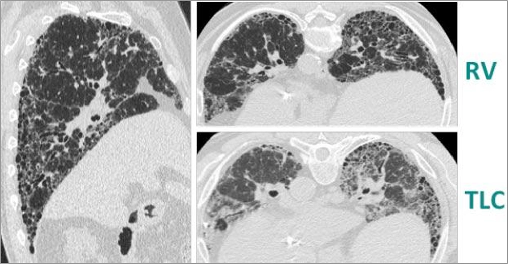 HRCT SCAN (1 OF 4) HRCT SCAN (1 OF 4)