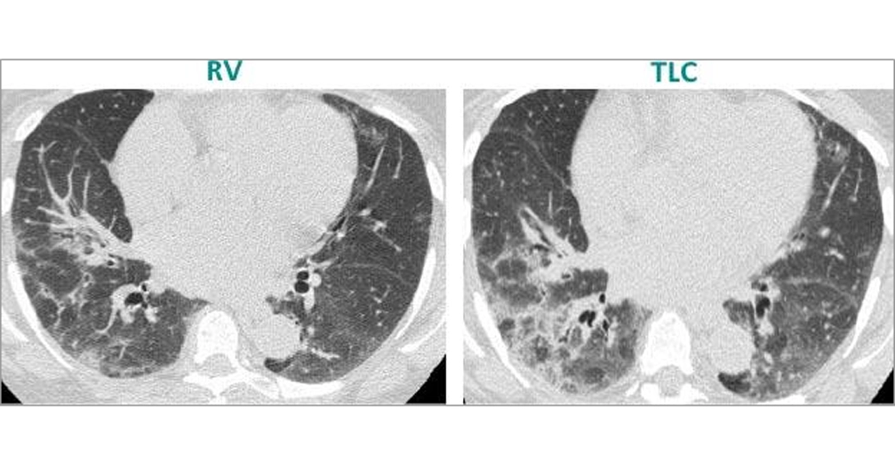 HRCT SCAN (2 OF 4) HRCT SCAN (2 OF 4)