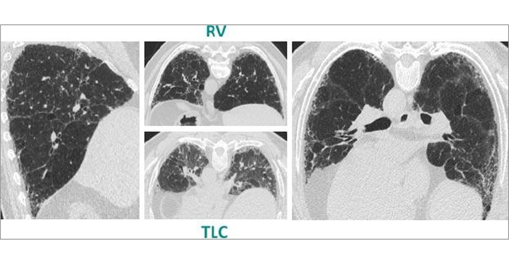 HRCT scan 3 of 4 HRCT scan 3 of 4