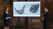 Interstitial lung disease in systemic sclerosis with a focus on chest CT