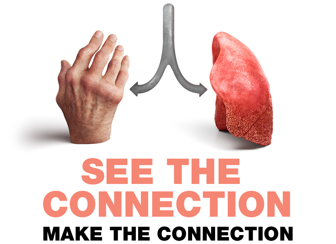 See The Connection Picture With Arthritic Hand And Lung Side By Side