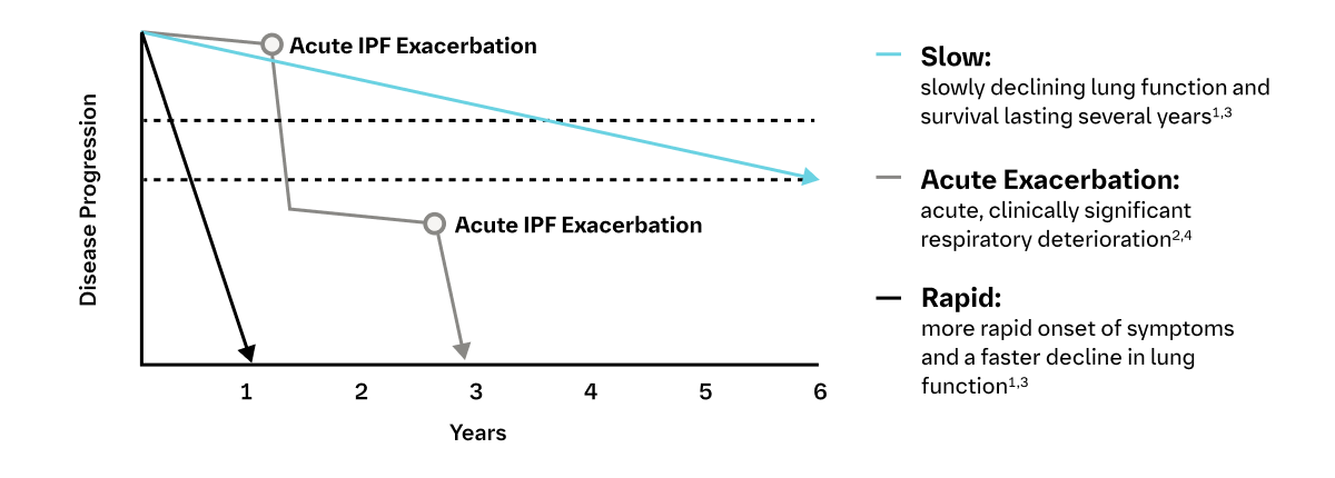 Acute exacerbations of IPF chart
