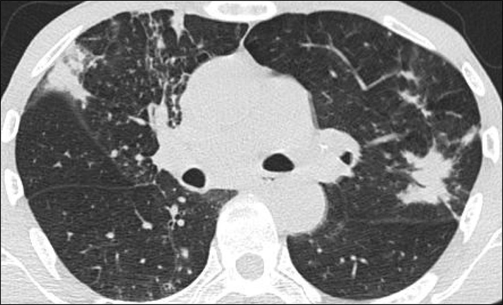Axial HRCT demonstrating consolidation