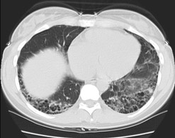 Chest X-ray with chronic dyspnea