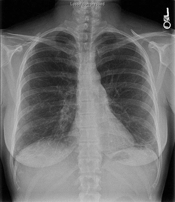 Chest X-Ray