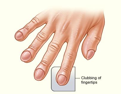 Clubbing of Fingertips