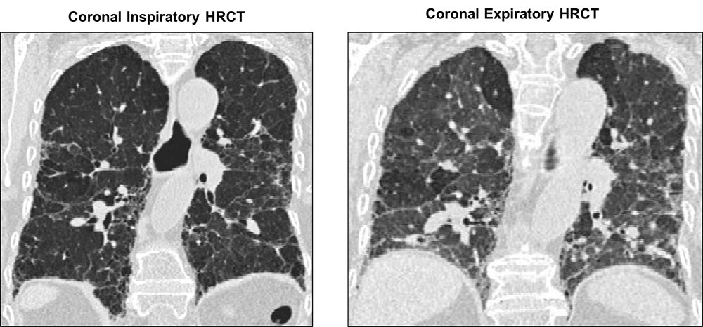 Coronal inspiratory and expiratory images