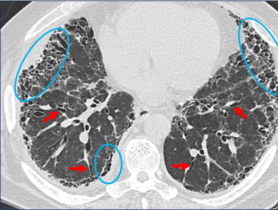 CT scan traction bronchiectasis