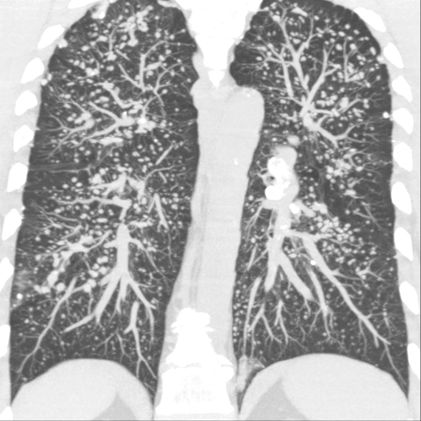 CTD - Upper-lung predominance