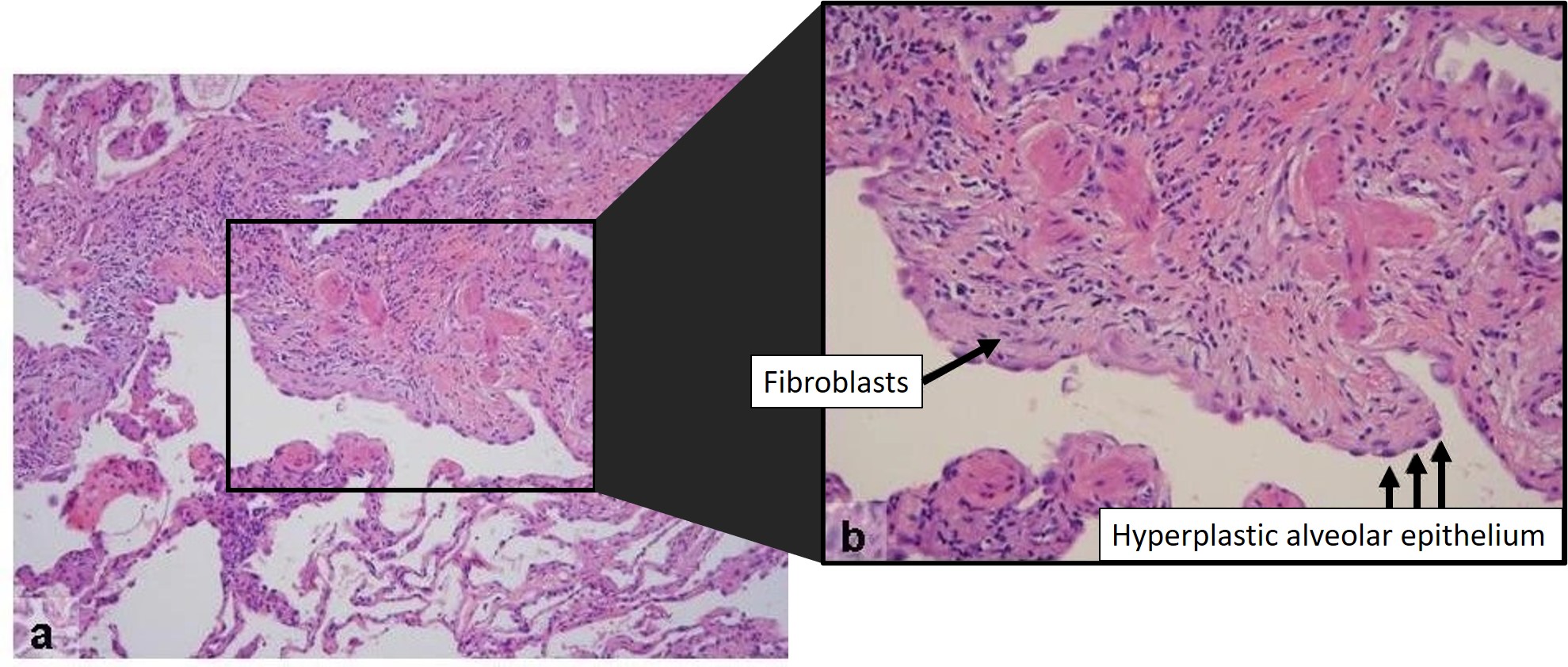Histopathologic features of usual interstitial pneumonia
