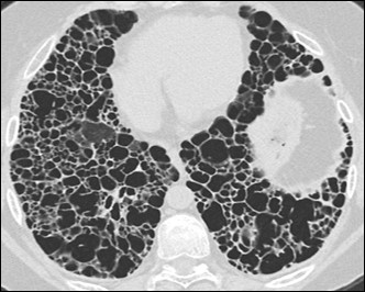 Distribution of UIP HRCT scan