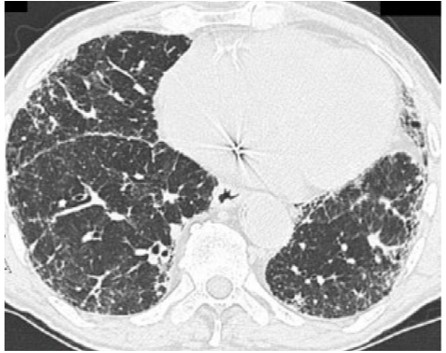 HRCT image with lack of honeycombing