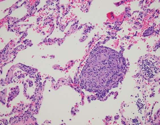 HRCT of Poorly Formed Granulomas / Bronchiolocentric With UIP