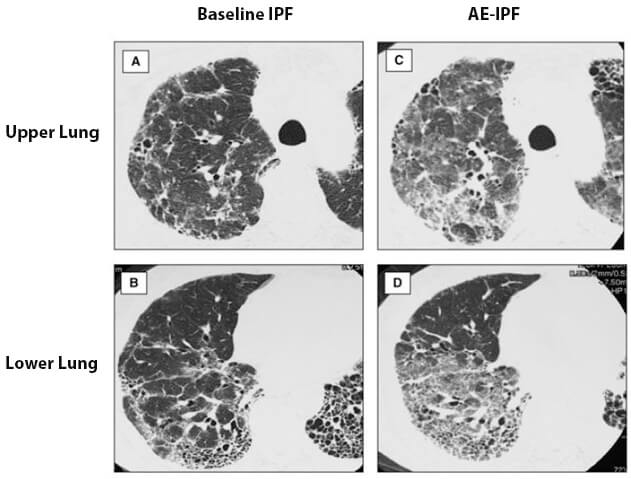 Signs of AE-IPF show up on HRCT Scans