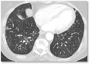 HRCT Scan Thumbnail HRCT Scan Thumbnail