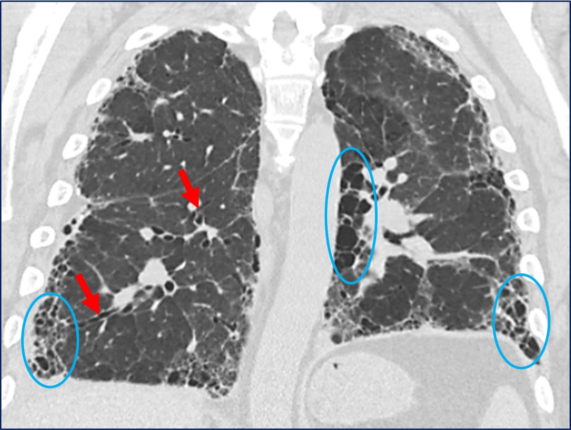 HRCT Traction Bronchiectasis & Honey Combing Features