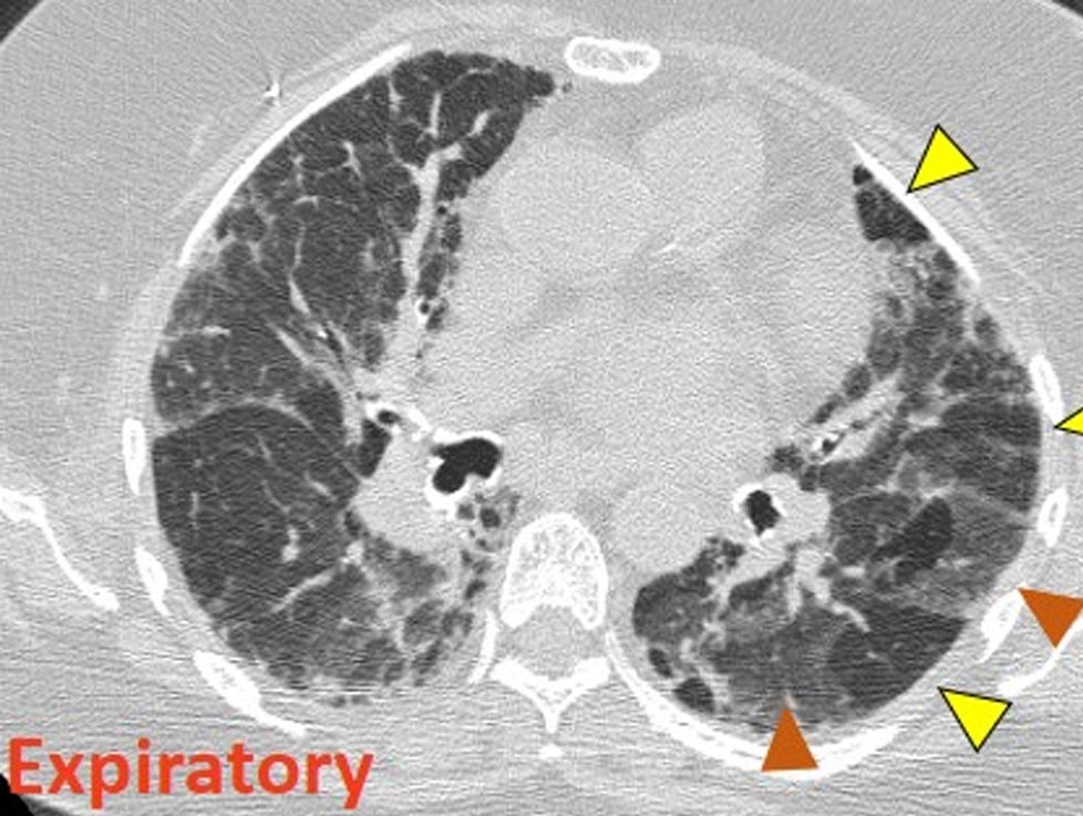 Low Magnification Photomicrograph Expiratory Features