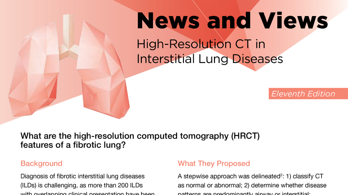 News And Views AI And Quantification In ILD PDF Download