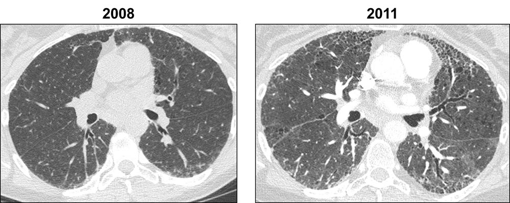 sagittal HRCT images
