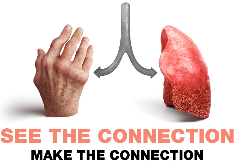 See The Connection Picture With Arthritic Hand And Lung Side By Side