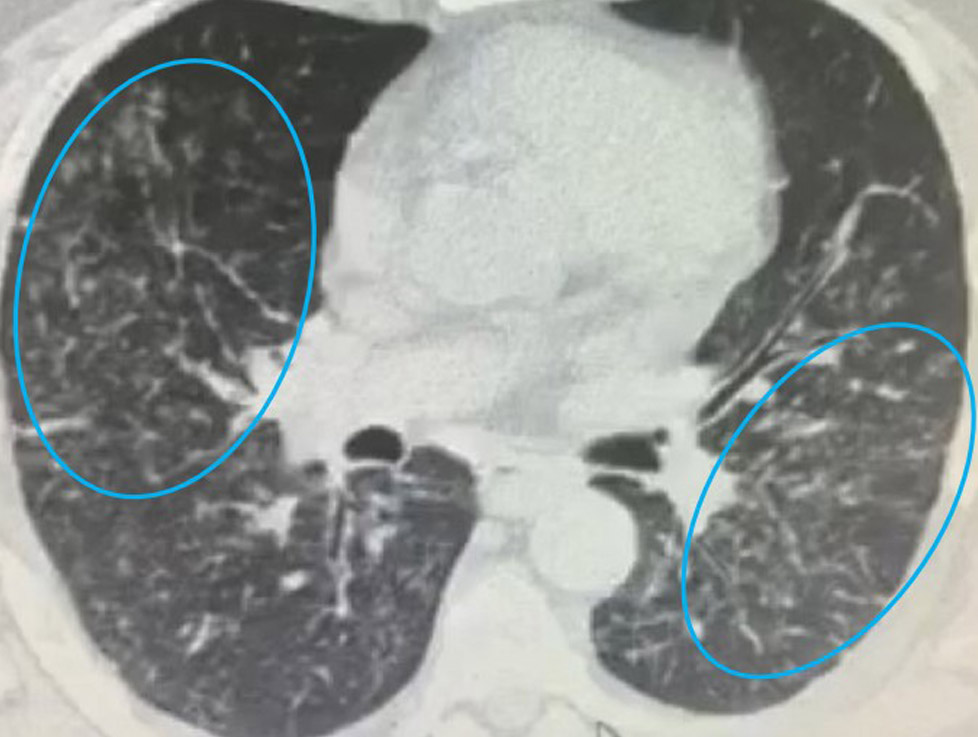 Small nodules abundant in the mid-lung. Small nodules abundant in the mid-lung.