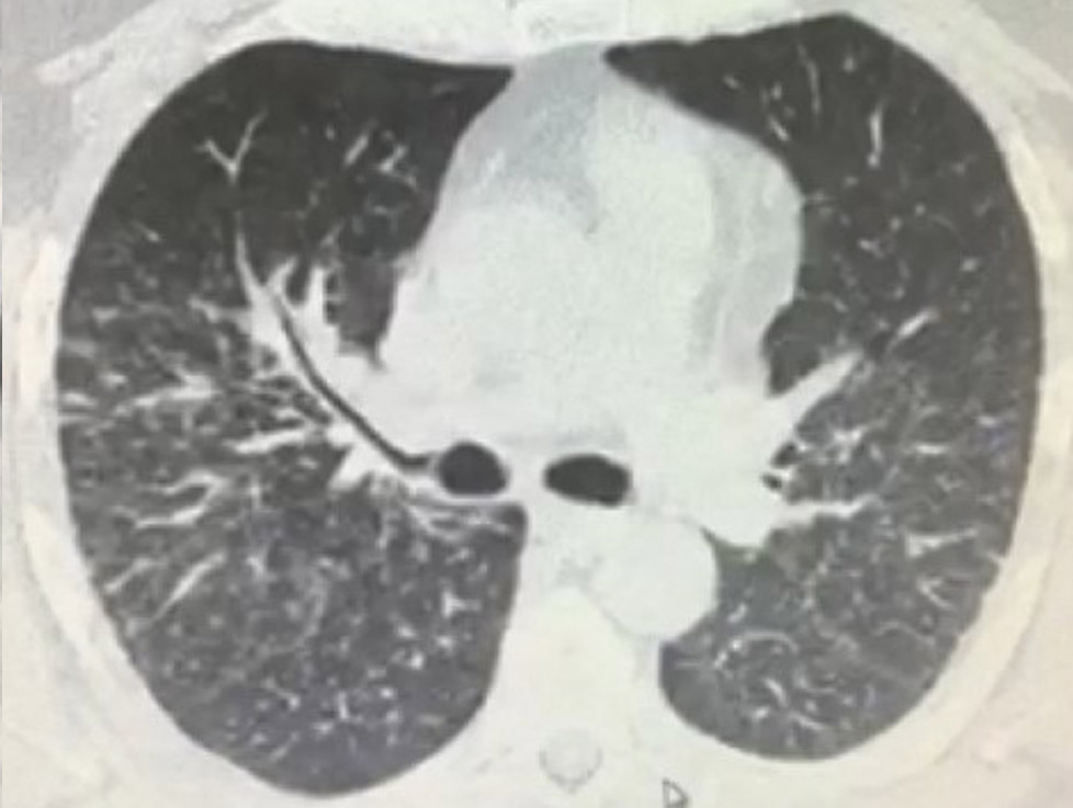 Small Nodules Abundant In The Mid-lung Small Nodules Abundant In The Mid-lung