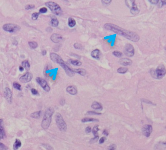 pathology from VATS biopsy pathology from VATS biopsy