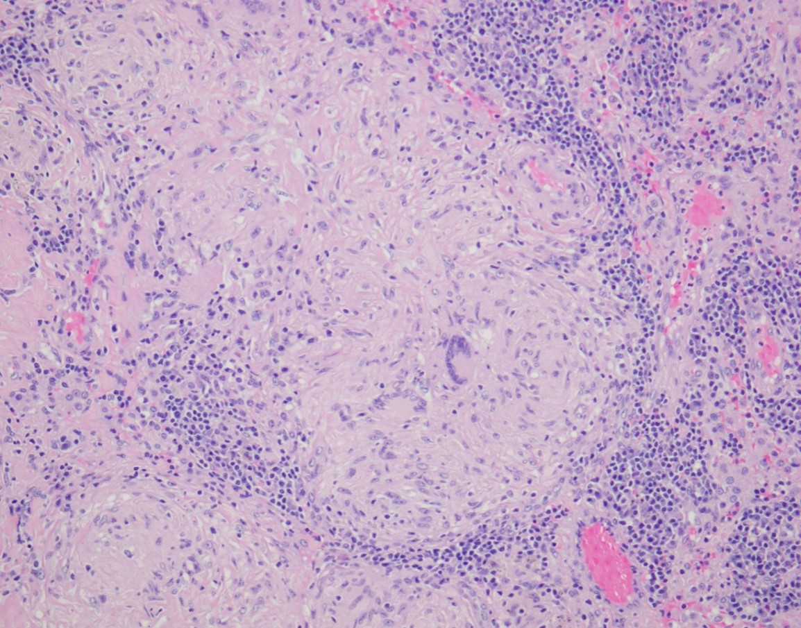 VATS pathology biopsy VATS pathology biopsy