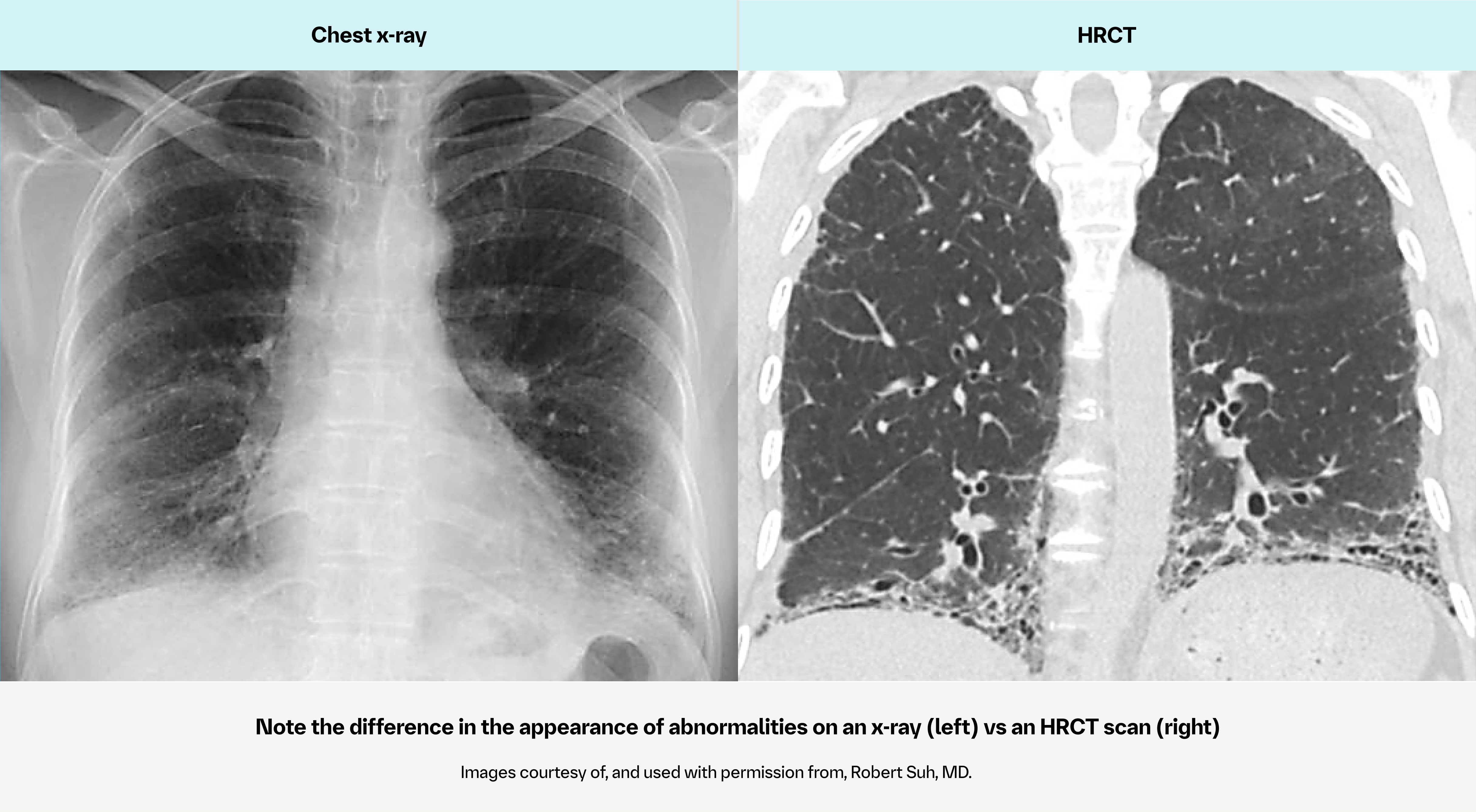Comparison of chest x-ray and HRCT showing lung abnormalities more clearly on HRCT