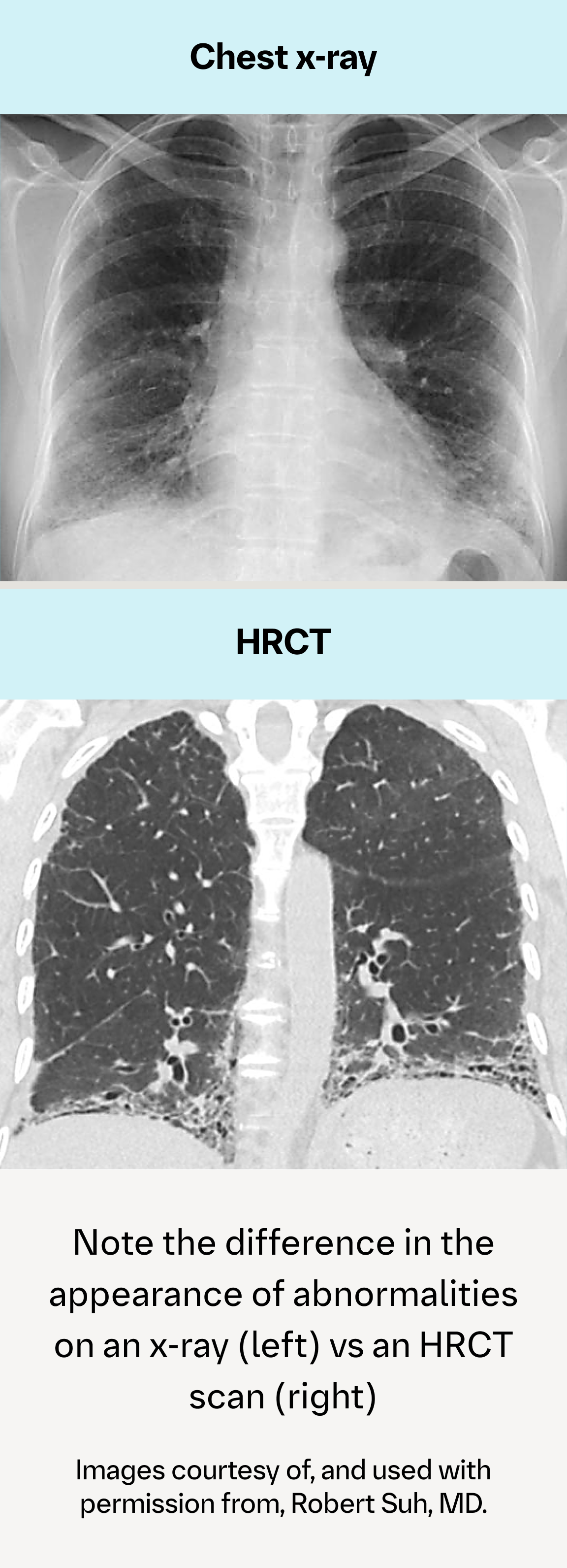 Comparison of chest x-ray and HRCT showing lung abnormalities more clearly on HRCT Comparison of chest x-ray and HRCT showing lung abnormalities more clearly on HRCT
